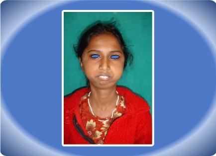 TEMPOROMANDIBULAR ANKYLOSIS